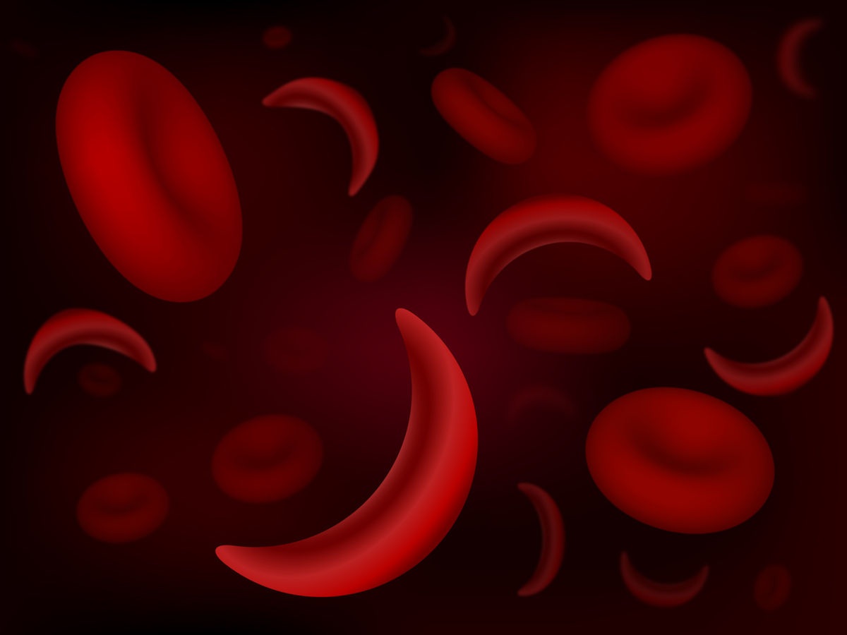 A anemia falciforme faz com que os glóbulos vermelhos adoptem uma forma de "C" ou de foice. As pessoas com esta doença carecem de uma proteína que dá aos glóbulos vermelhos uma forma rígida que os ajuda a transportar oxigénio por todo o corpo. Transportar menos oxigénio significa que as pessoas com anemia falciforme têm menos glóbulos vermelhos e podem vir a ter vasos sanguíneos obstruídos e, potencialmente, um enfarte.  