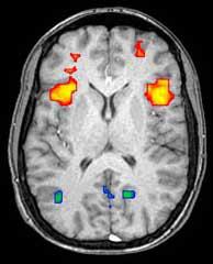 Um exemplo de como é uma imagem de fMRI- as regiões cerebrais que estão activadas num determinado momento (a vermelho) podem ser distinguidas daquelas que estão menos activadas (a azul). Este tipo de imagens ajuda os cientistas a mapearem as áreas do cérebro que estão a ser usadas por uma pessoa quando está a resolver um problema.