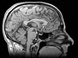 O volume máximo atingido pelo cérebro pode ser menor em homens com a mutação DH  