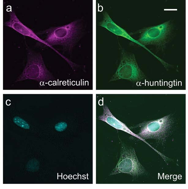 Nesta imagem de microscopia do laboratório do Dr. Truant, diferentes cores são utilizadas para mostrar diferentes partes da célula. O núcleo é exposto por um corante chamado 'Hoechst'. A huntingtina foi alterada de modo a ter um brilho esverdeado, permitindo que seja identificada na célula.  