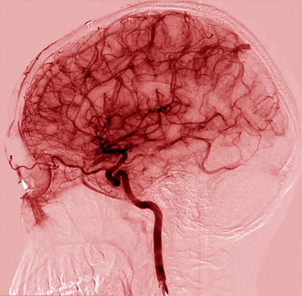 Esta é uma imagem dos muitos vasos sanguíneos do cérebro. As células que revestem estes vasos criam a barreira hemato-encefálica.   
