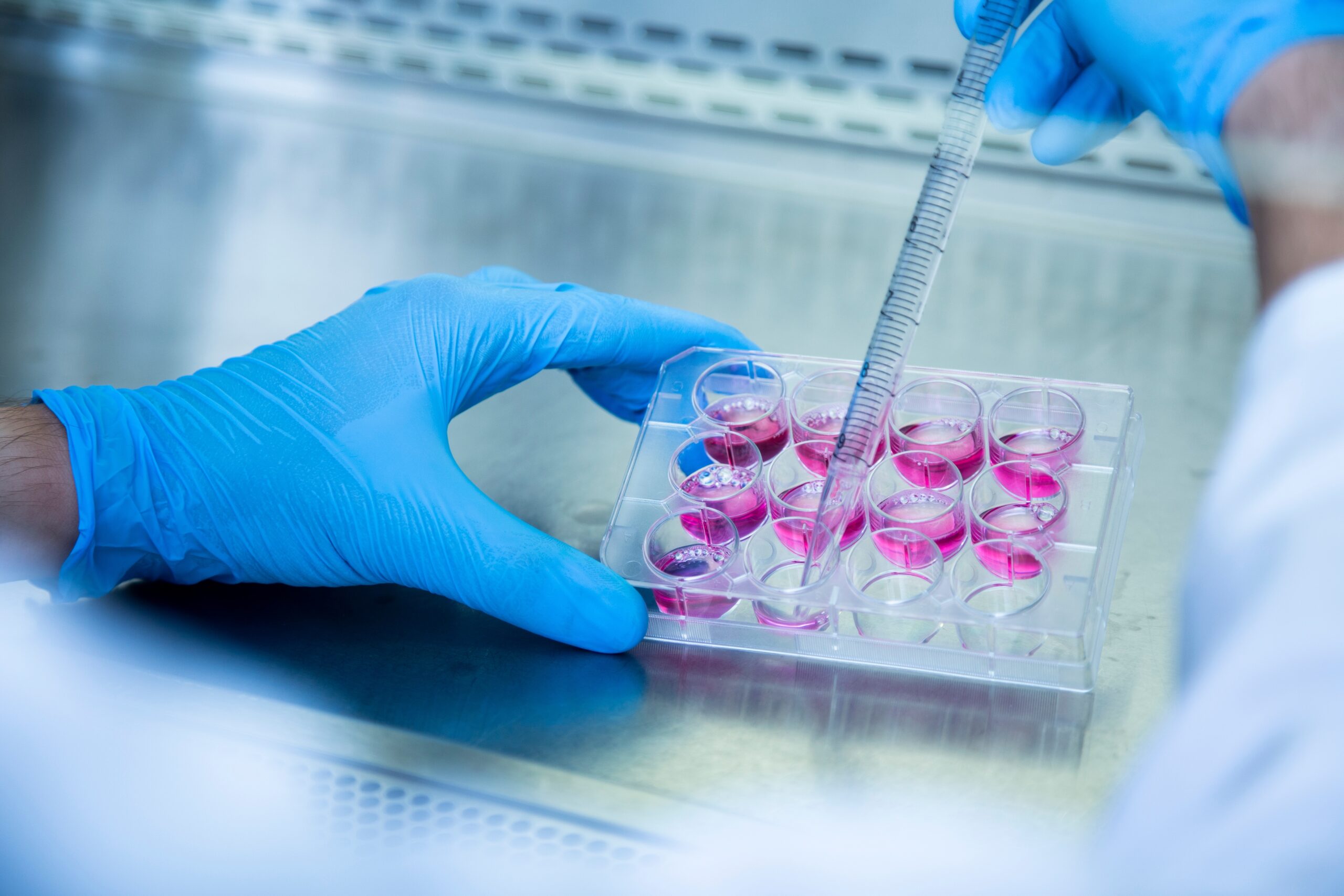 Mini-cérebros cultivados numa placa de Petri trazem novas informações sobre a doença de Huntington e a forma de a tratar